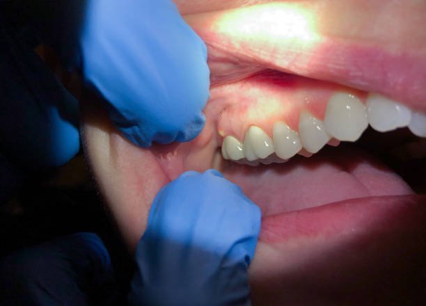 Best Walk-In Emergency Dentist in Braselton, GA